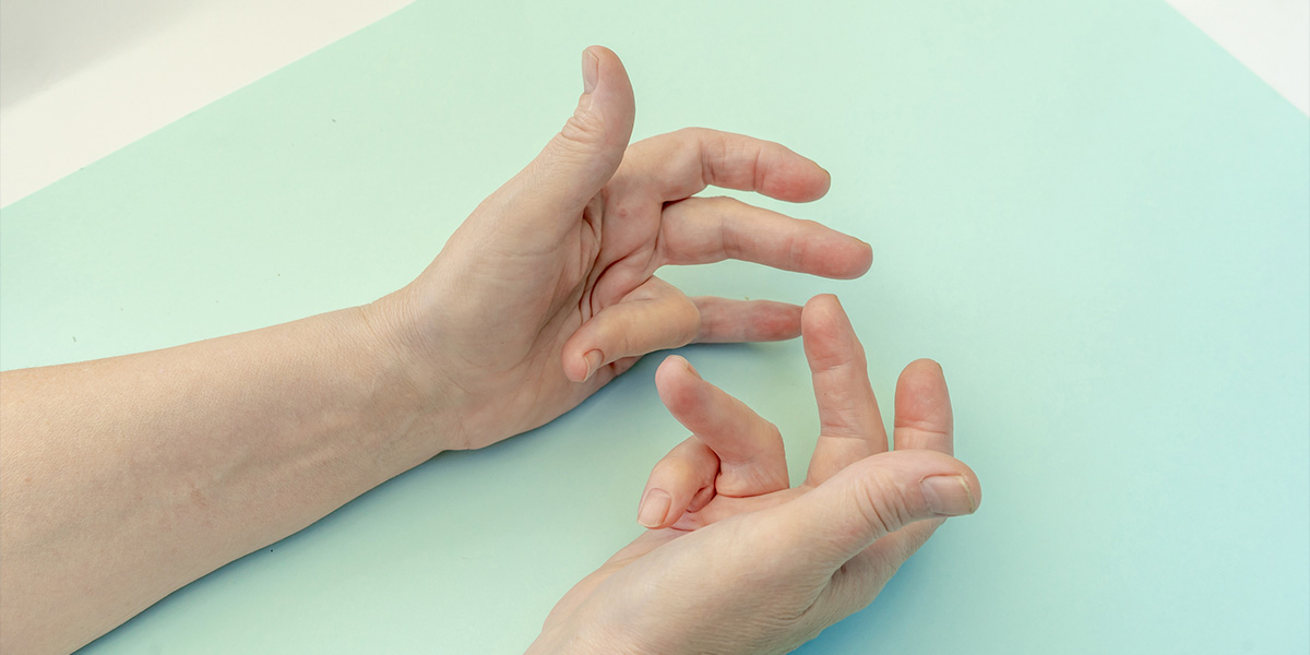 Nonsurgical Treatment for Dupuytren's Contracture